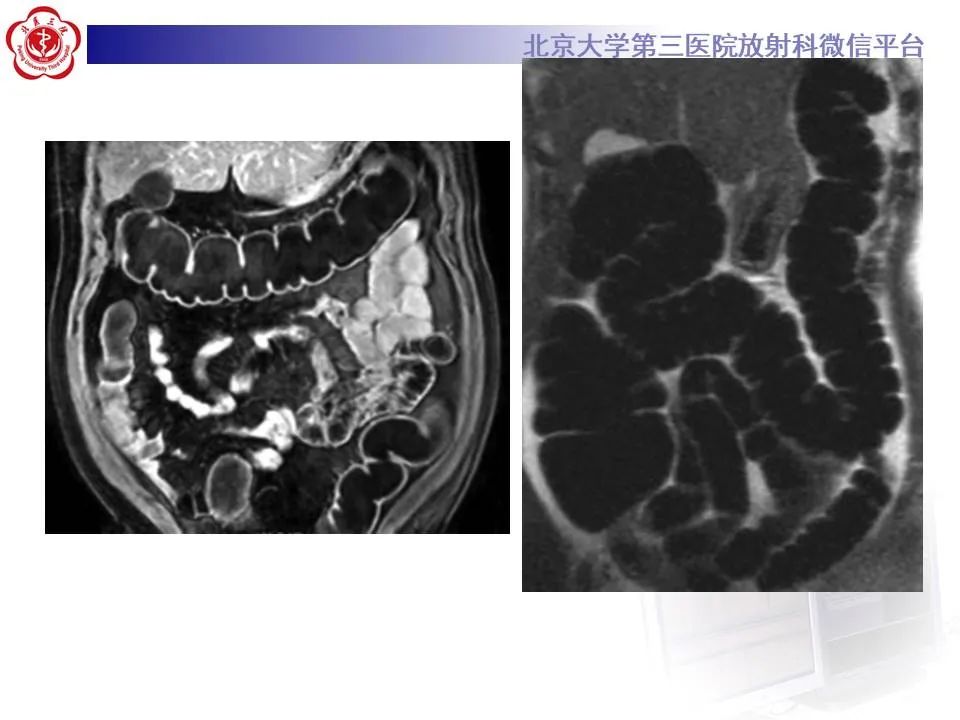 【PPT】炎症性肠病的CT/MRI诊断 第三部分:检查方法