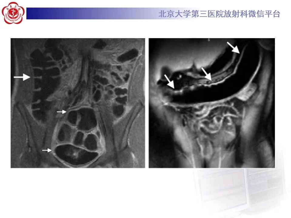 【PPT】炎症性肠病的CT/MRI诊断 第三部分:检查方法
