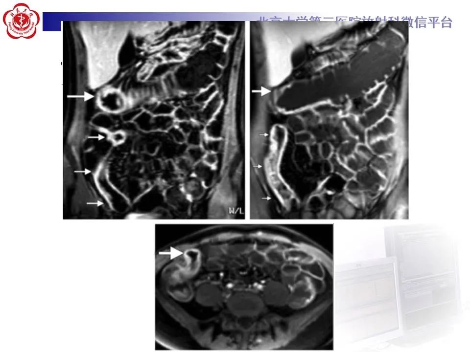 【PPT】炎症性肠病的CT/MRI诊断 第三部分:检查方法
