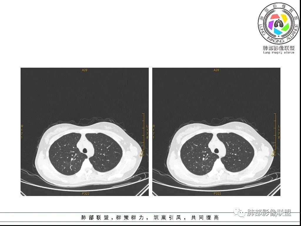 【病例】右肺炎症性病变1例CT影像讨论 【病例】右肺炎症性病变1例CT影像讨论