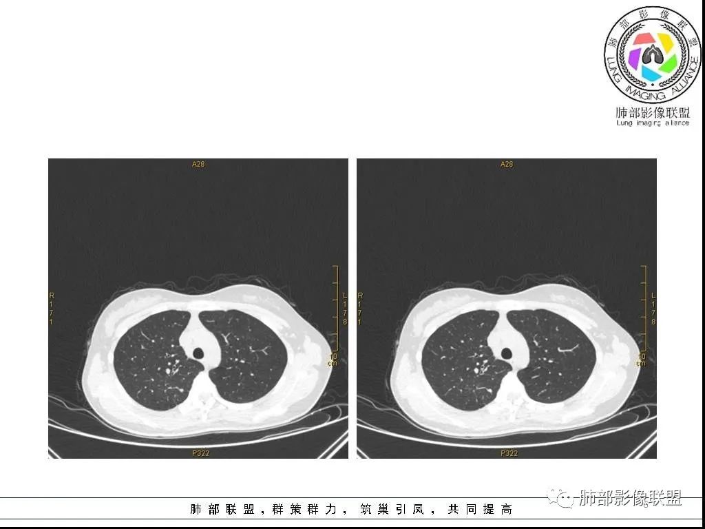 【病例】右肺炎症性病变1例CT影像讨论 【病例】右肺炎症性病变1例CT影像讨论