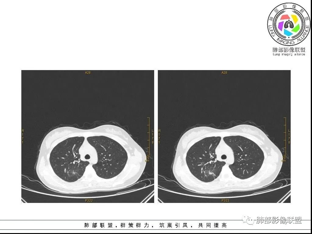 【病例】右肺炎症性病变1例CT影像讨论 【病例】右肺炎症性病变1例CT影像讨论