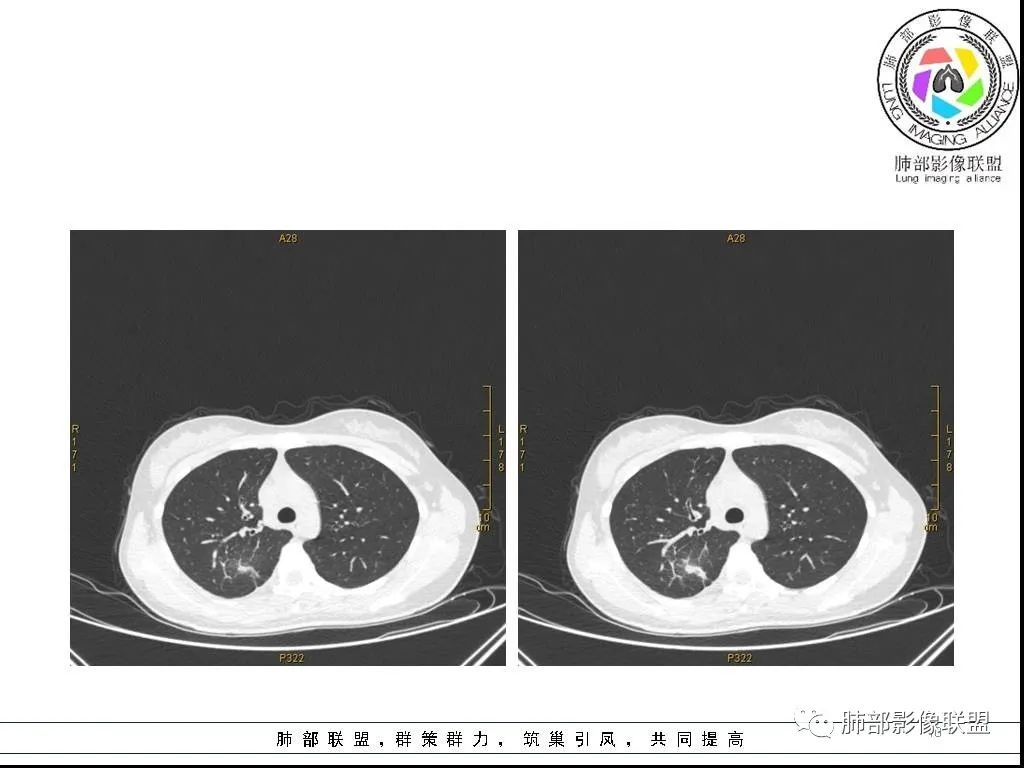 【病例】右肺炎症性病变1例CT影像讨论 【病例】右肺炎症性病变1例CT影像讨论