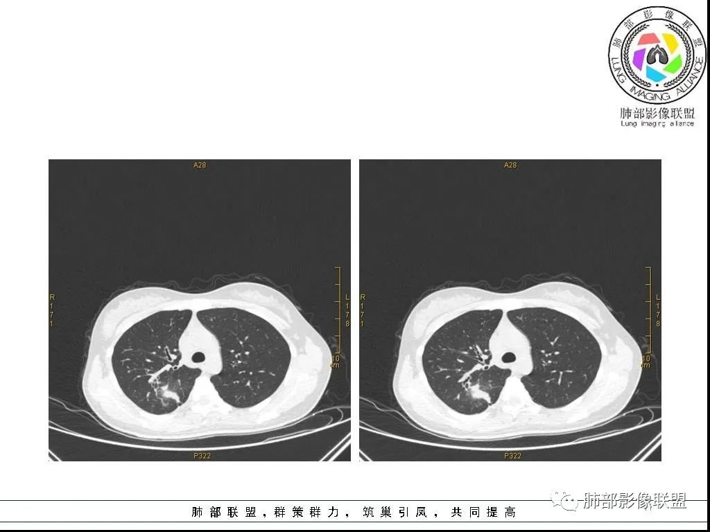 【病例】右肺炎症性病变1例CT影像讨论 【病例】右肺炎症性病变1例CT影像讨论