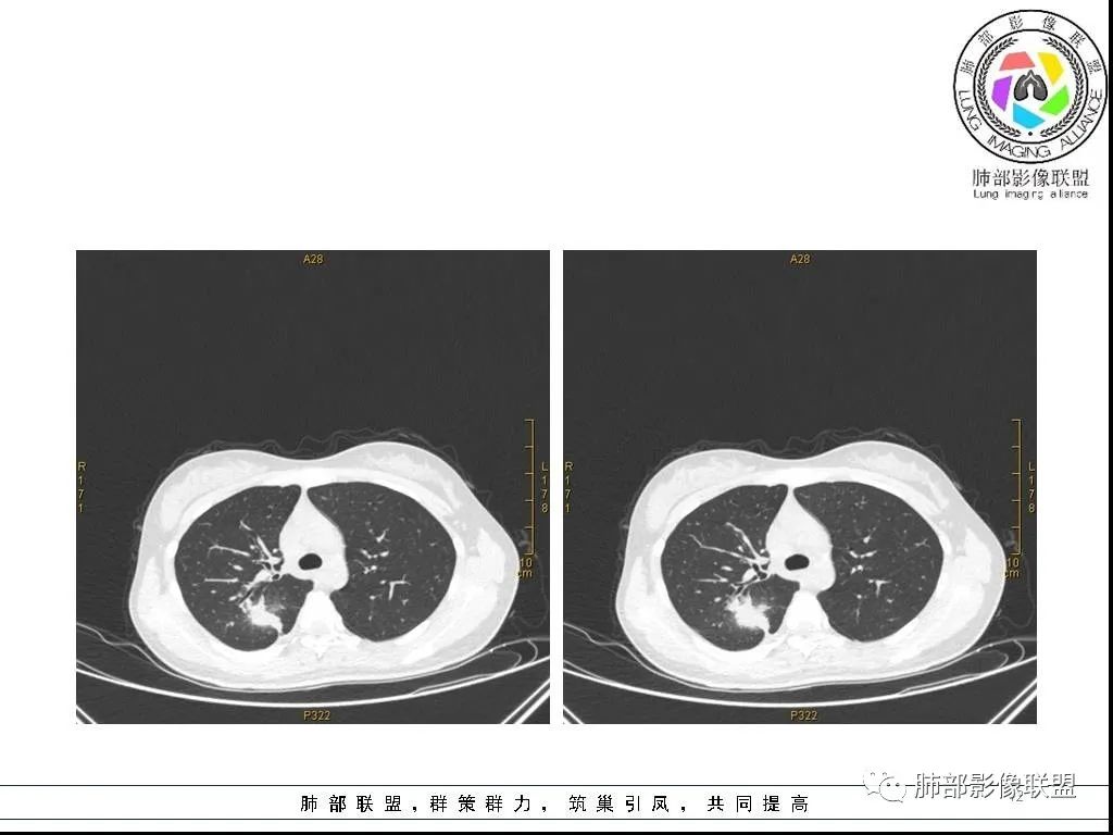 【病例】右肺炎症性病变1例CT影像讨论 【病例】右肺炎症性病变1例CT影像讨论