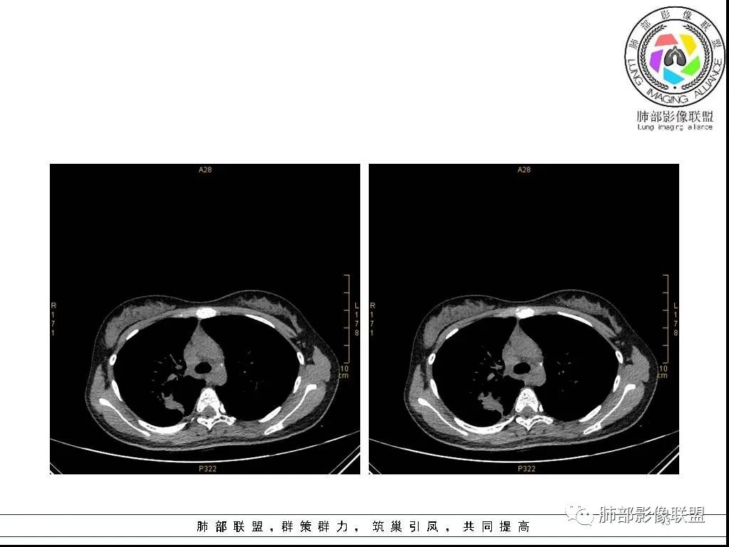 【病例】右肺炎症性病变1例CT影像讨论 【病例】右肺炎症性病变1例CT影像讨论