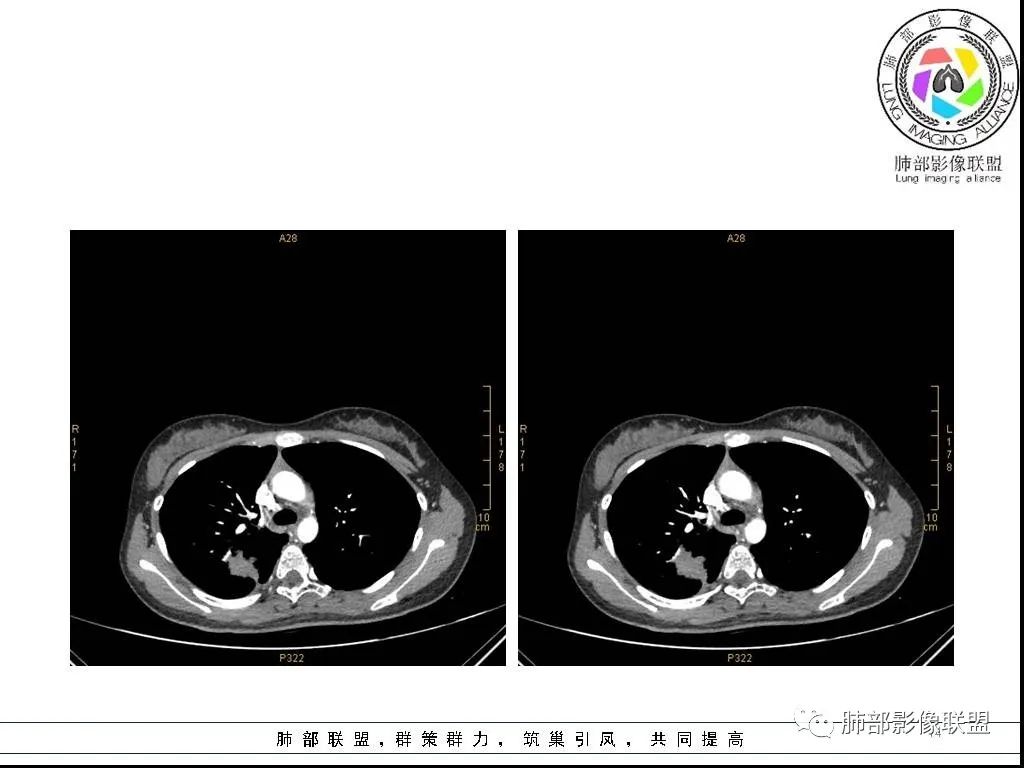 【病例】右肺炎症性病变1例CT影像讨论 【病例】右肺炎症性病变1例CT影像讨论