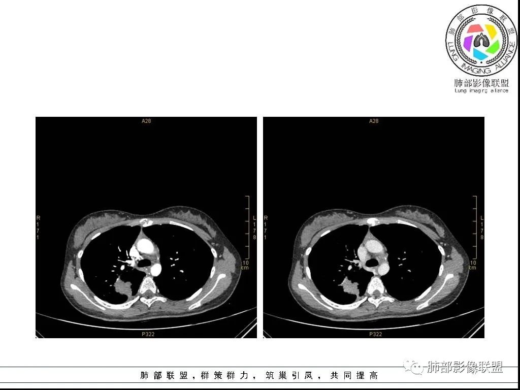 【病例】右肺炎症性病变1例CT影像讨论 【病例】右肺炎症性病变1例CT影像讨论