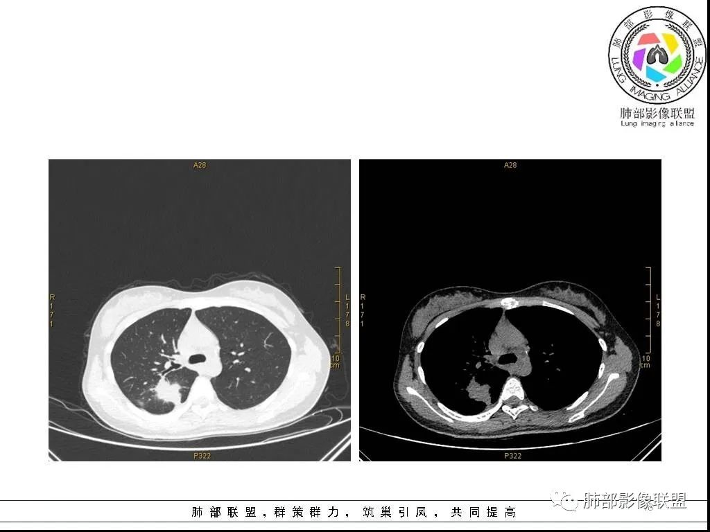 【病例】右肺炎症性病变1例CT影像讨论 【病例】右肺炎症性病变1例CT影像讨论