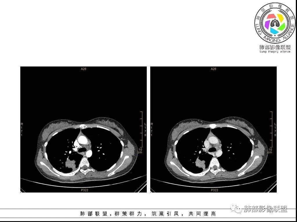 【病例】右肺炎症性病变1例CT影像讨论 【病例】右肺炎症性病变1例CT影像讨论