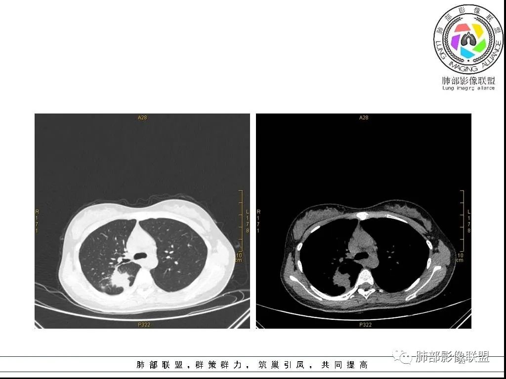 【病例】右肺炎症性病变1例CT影像讨论 【病例】右肺炎症性病变1例CT影像讨论