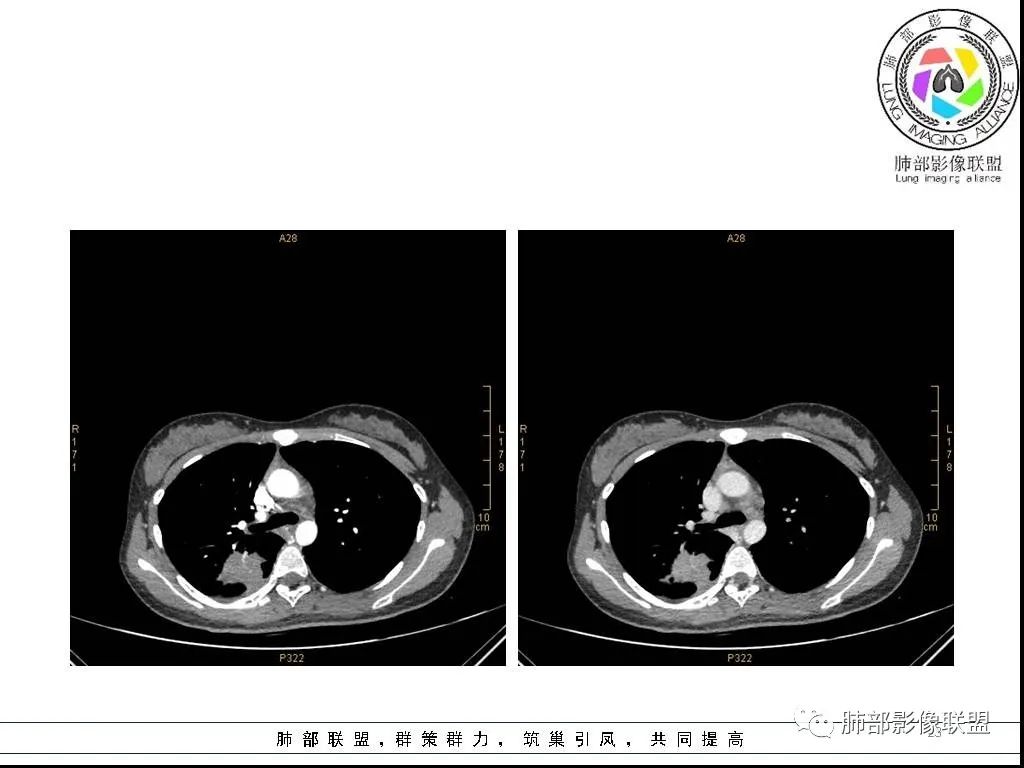 【病例】右肺炎症性病变1例CT影像讨论 【病例】右肺炎症性病变1例CT影像讨论