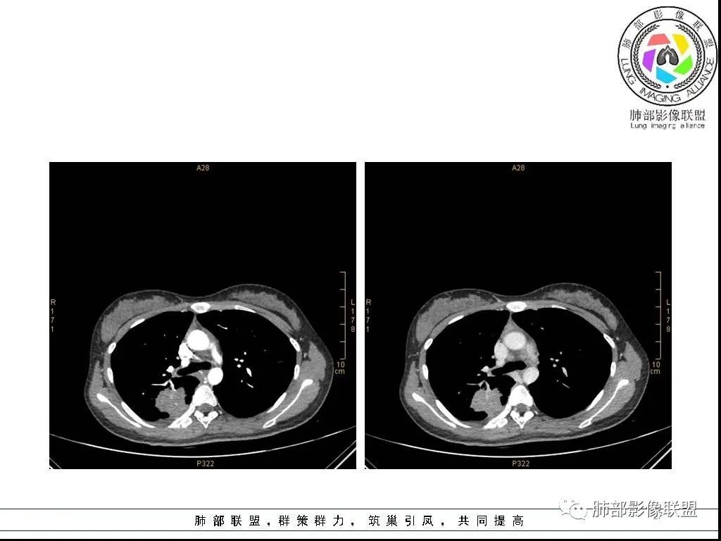 【病例】右肺炎症性病变1例CT影像讨论 【病例】右肺炎症性病变1例CT影像讨论