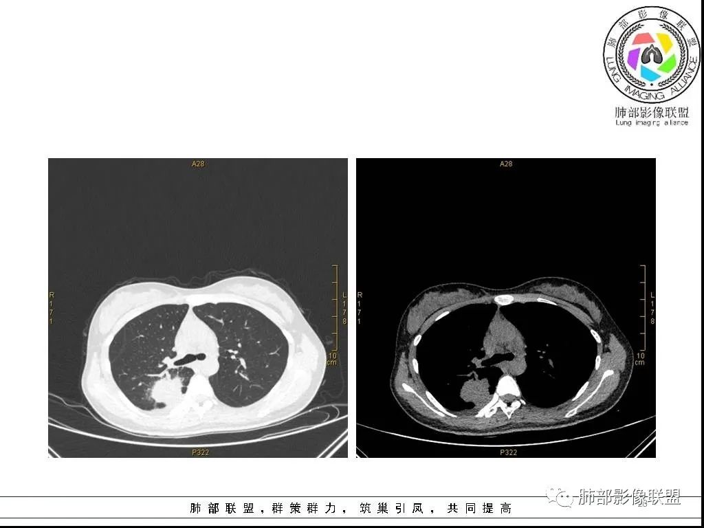 【病例】右肺炎症性病变1例CT影像讨论 【病例】右肺炎症性病变1例CT影像讨论