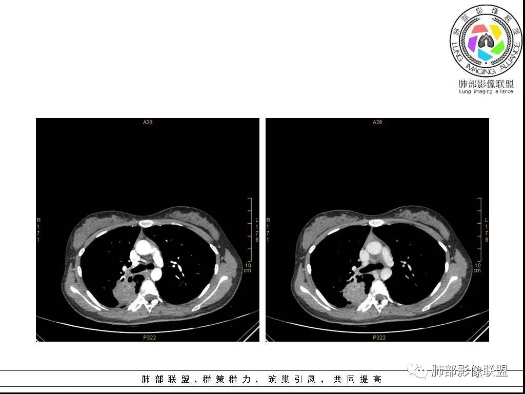 【病例】右肺炎症性病变1例CT影像讨论 【病例】右肺炎症性病变1例CT影像讨论