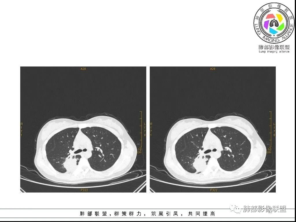 【病例】右肺炎症性病变1例CT影像讨论 【病例】右肺炎症性病变1例CT影像讨论