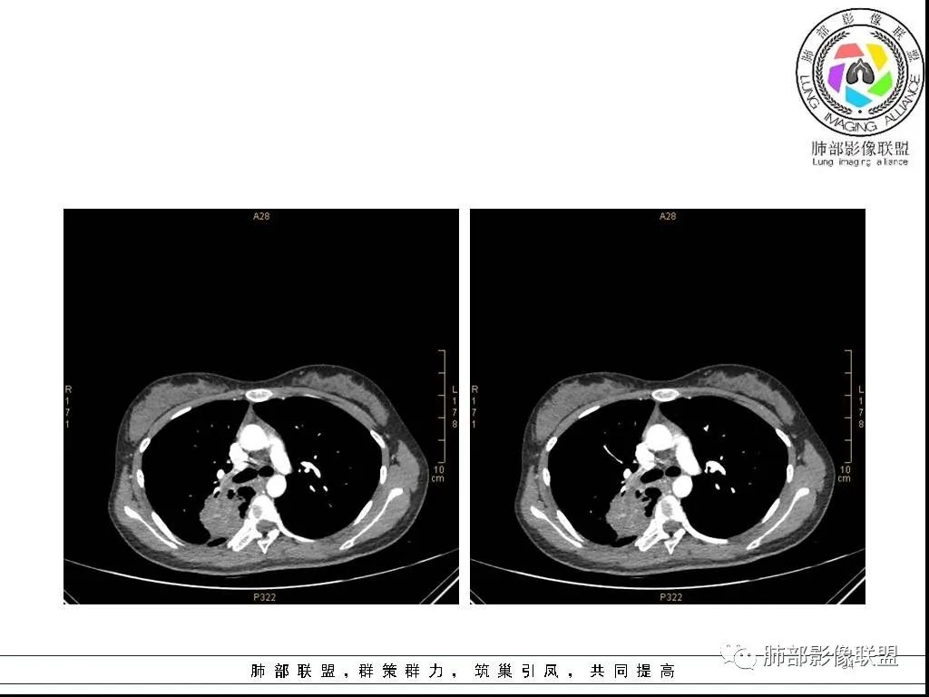 【病例】右肺炎症性病变1例CT影像讨论 【病例】右肺炎症性病变1例CT影像讨论