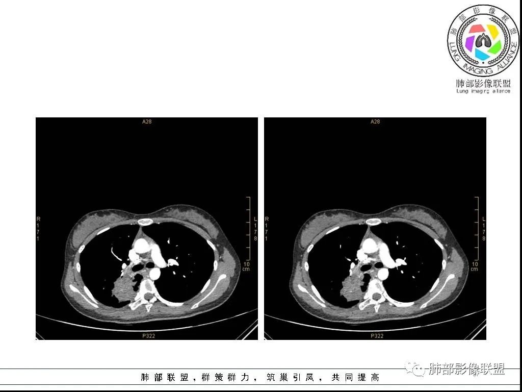 【病例】右肺炎症性病变1例CT影像讨论 【病例】右肺炎症性病变1例CT影像讨论