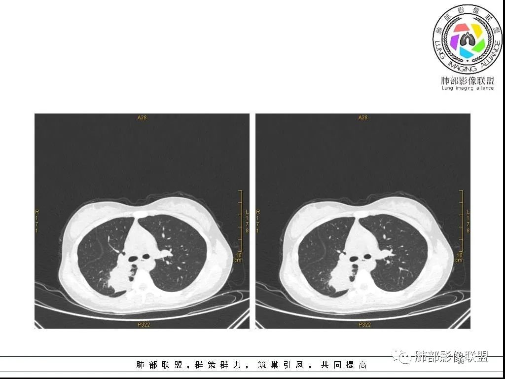 【病例】右肺炎症性病变1例CT影像讨论 【病例】右肺炎症性病变1例CT影像讨论