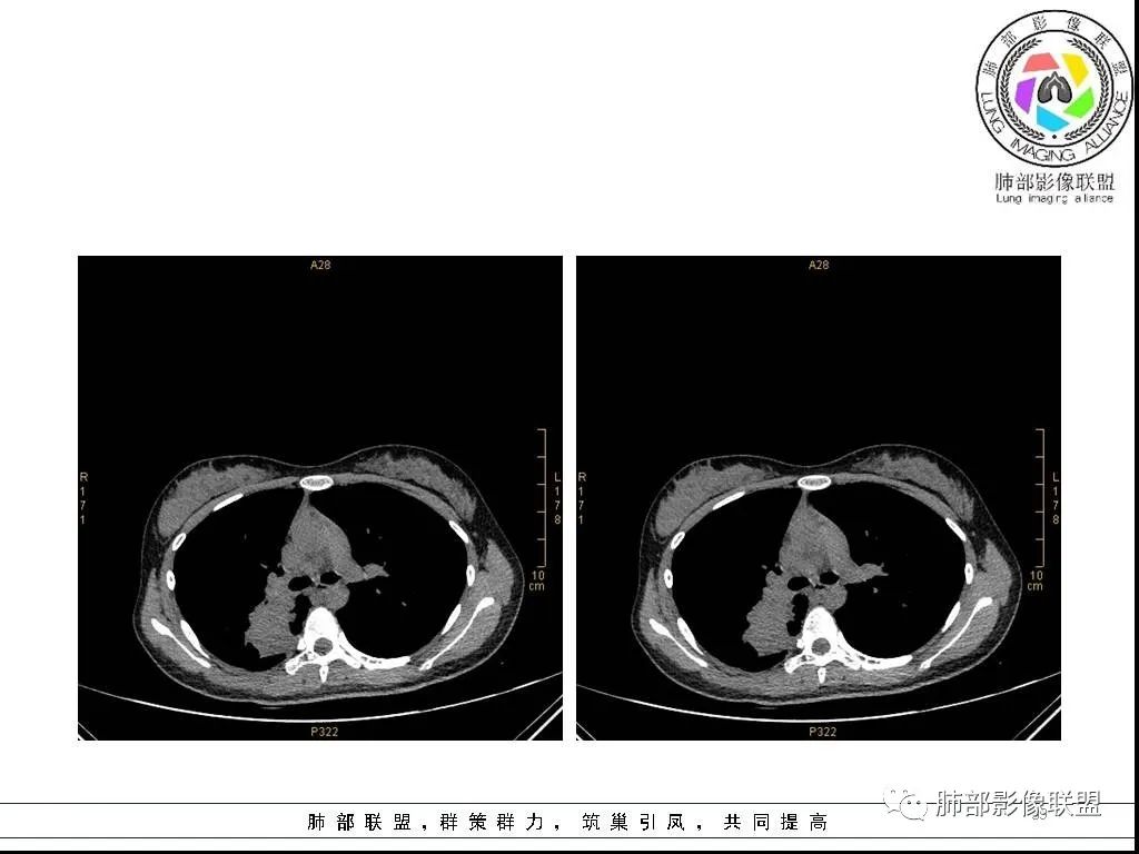 【病例】右肺炎症性病变1例CT影像讨论 【病例】右肺炎症性病变1例CT影像讨论