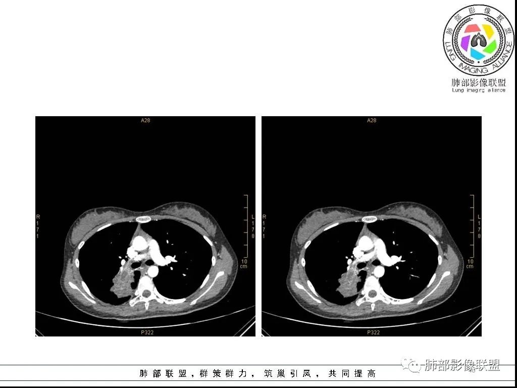 【病例】右肺炎症性病变1例CT影像讨论 【病例】右肺炎症性病变1例CT影像讨论