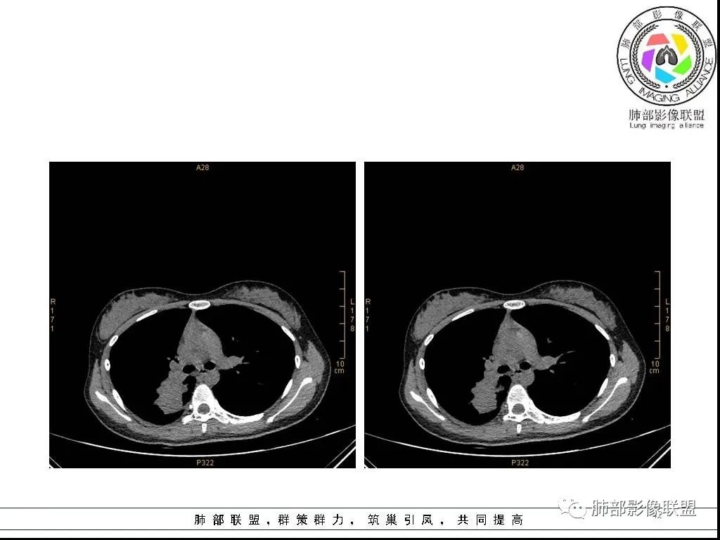 【病例】右肺炎症性病变1例CT影像讨论 【病例】右肺炎症性病变1例CT影像讨论