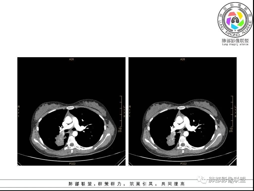 【病例】右肺炎症性病变1例CT影像讨论 【病例】右肺炎症性病变1例CT影像讨论