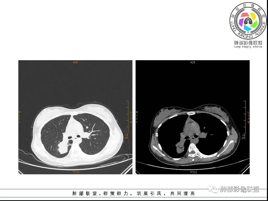 【病例】右肺炎症性病变1例CT影像讨论 【病例】右肺炎症性病变1例CT影像讨论
