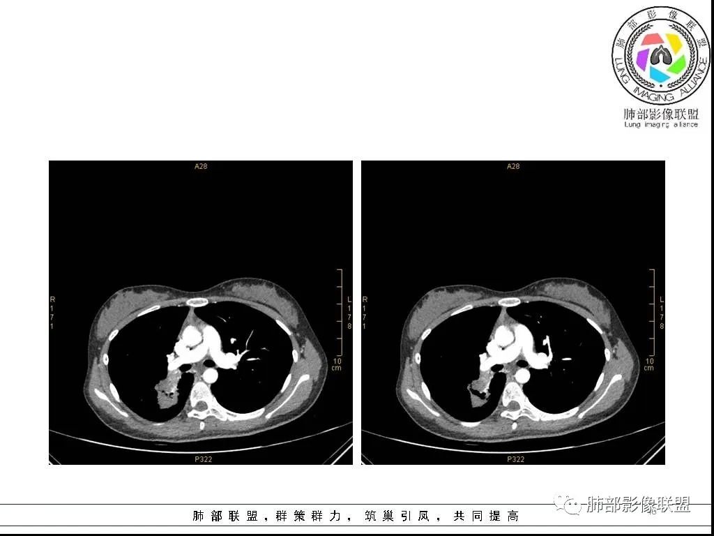 【病例】右肺炎症性病变1例CT影像讨论 【病例】右肺炎症性病变1例CT影像讨论