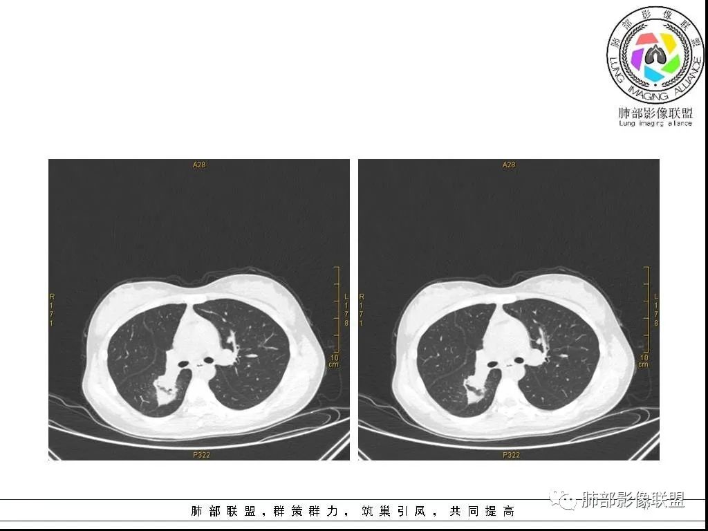 【病例】右肺炎症性病变1例CT影像讨论 【病例】右肺炎症性病变1例CT影像讨论