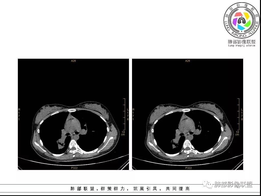 【病例】右肺炎症性病变1例CT影像讨论 【病例】右肺炎症性病变1例CT影像讨论