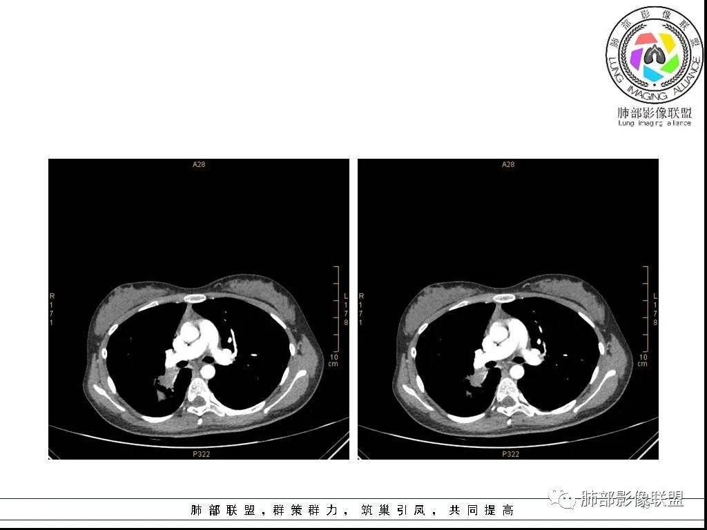 【病例】右肺炎症性病变1例CT影像讨论 【病例】右肺炎症性病变1例CT影像讨论