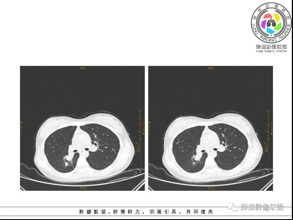 【病例】右肺炎症性病变1例CT影像讨论 【病例】右肺炎症性病变1例CT影像讨论