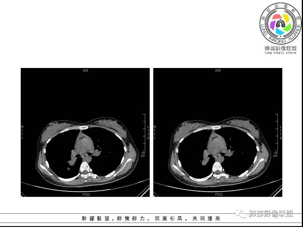 【病例】右肺炎症性病变1例CT影像讨论 【病例】右肺炎症性病变1例CT影像讨论