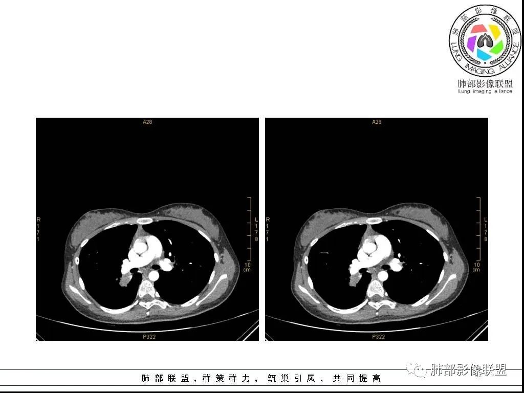 【病例】右肺炎症性病变1例CT影像讨论 【病例】右肺炎症性病变1例CT影像讨论