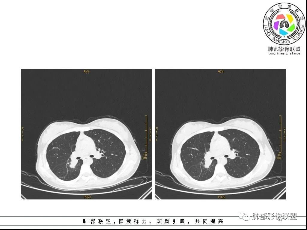 【病例】右肺炎症性病变1例CT影像讨论 【病例】右肺炎症性病变1例CT影像讨论