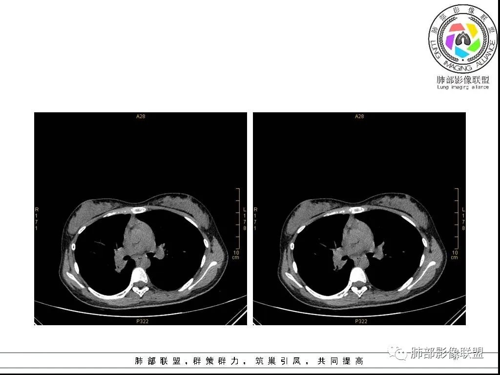 【病例】右肺炎症性病变1例CT影像讨论 【病例】右肺炎症性病变1例CT影像讨论