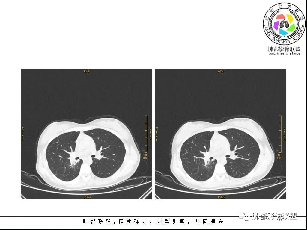 【病例】右肺炎症性病变1例CT影像讨论 【病例】右肺炎症性病变1例CT影像讨论