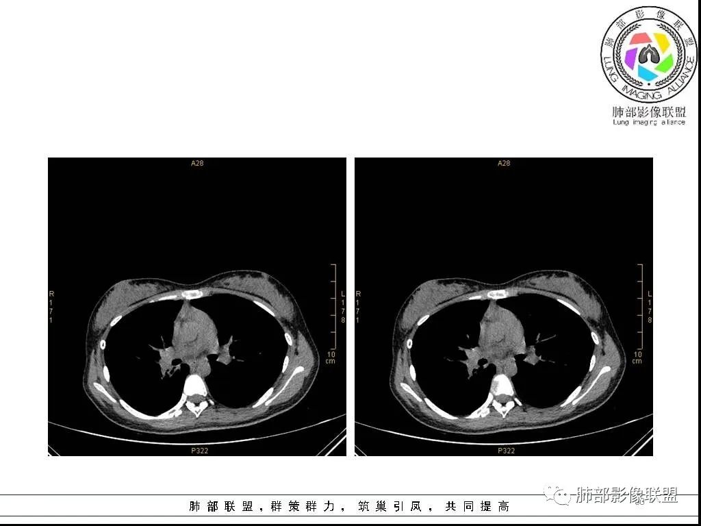 【病例】右肺炎症性病变1例CT影像讨论 【病例】右肺炎症性病变1例CT影像讨论