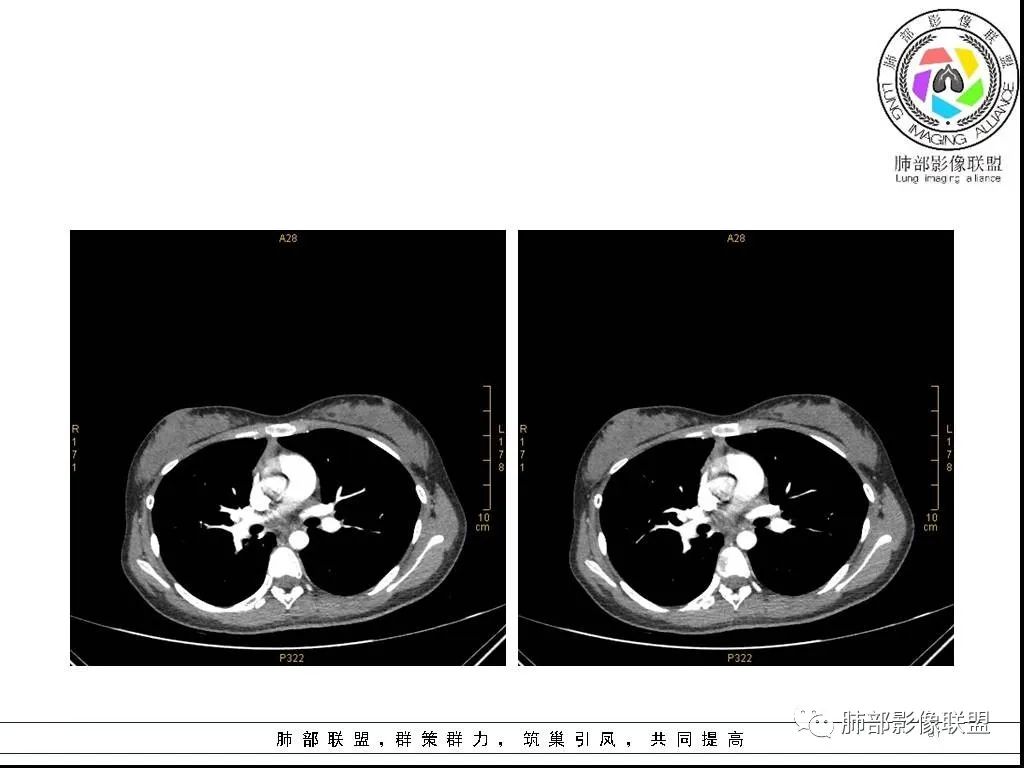 【病例】右肺炎症性病变1例CT影像讨论 【病例】右肺炎症性病变1例CT影像讨论