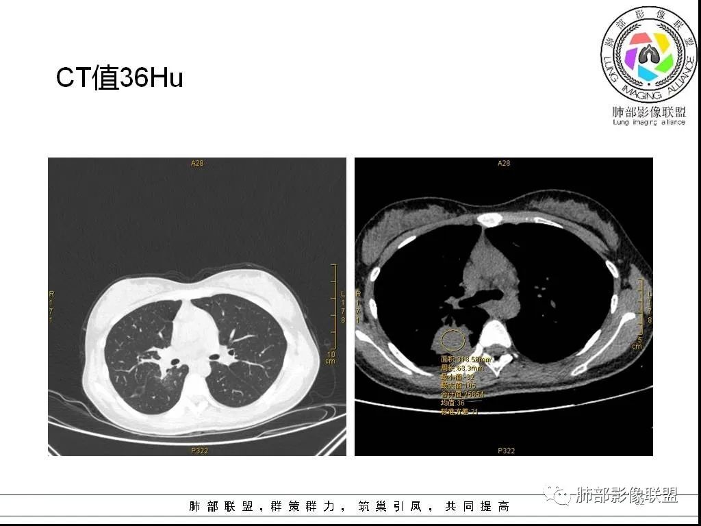 【病例】右肺炎症性病变1例CT影像讨论 【病例】右肺炎症性病变1例CT影像讨论