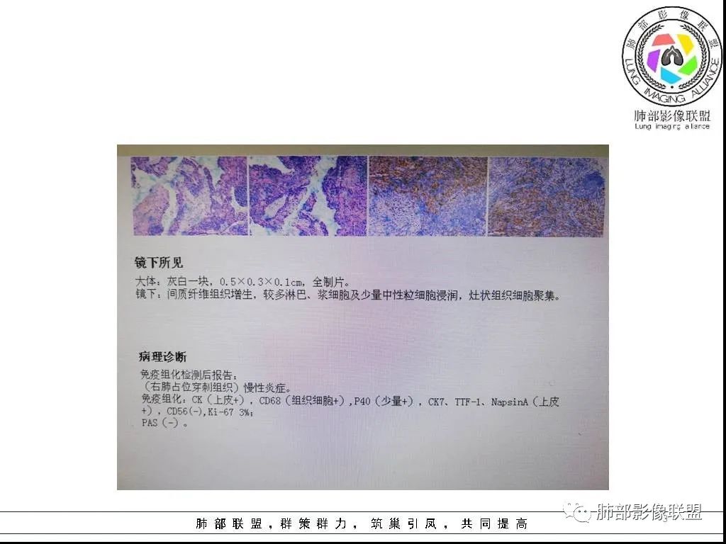 【病例】右肺炎症性病变1例CT影像讨论 【病例】右肺炎症性病变1例CT影像讨论