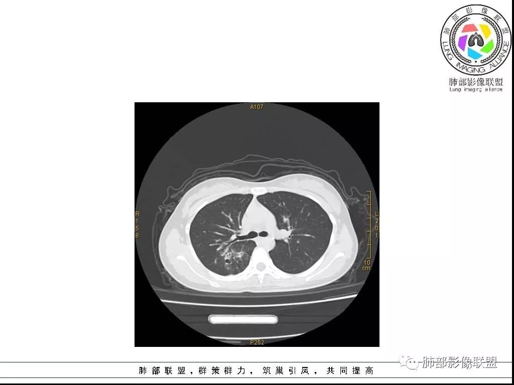 【病例】右肺炎症性病变1例CT影像讨论 【病例】右肺炎症性病变1例CT影像讨论