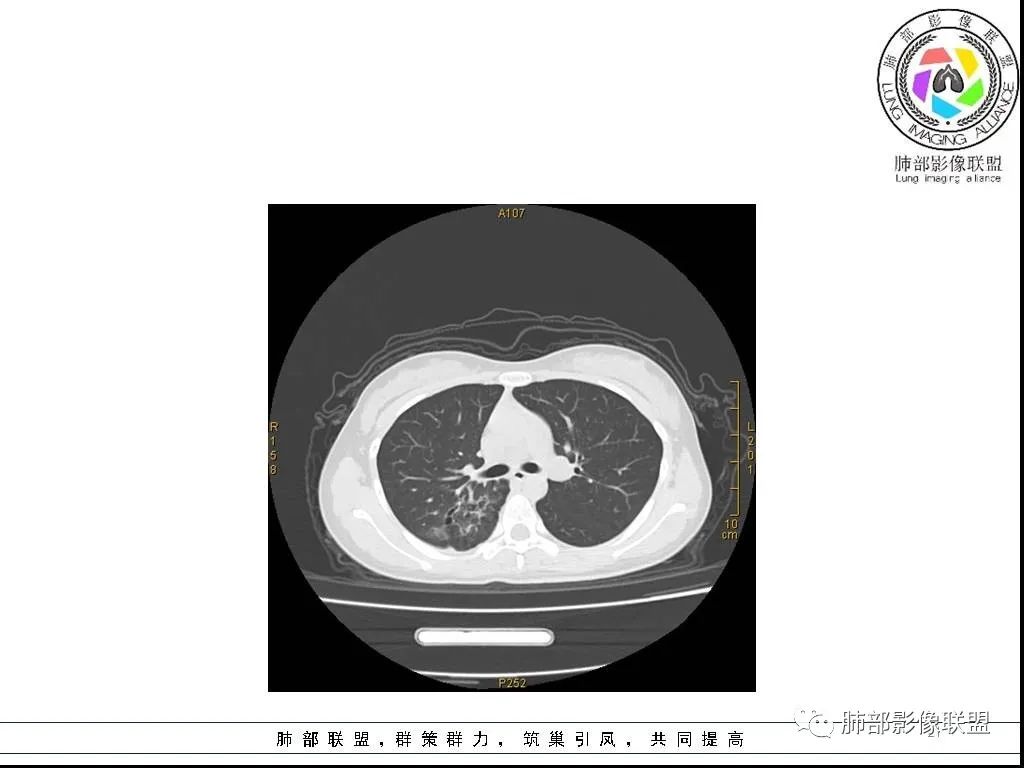 【病例】右肺炎症性病变1例CT影像讨论 【病例】右肺炎症性病变1例CT影像讨论