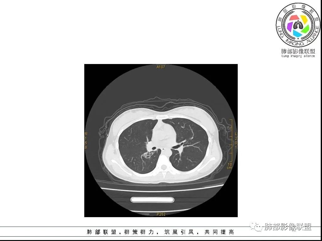 【病例】右肺炎症性病变1例CT影像讨论 【病例】右肺炎症性病变1例CT影像讨论