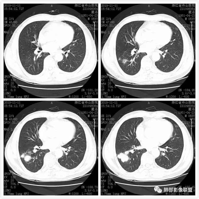 【病例】诡异的尿路肺转移瘤1例CT影像 【病例】诡异的尿路肺转移瘤1例CT影像
