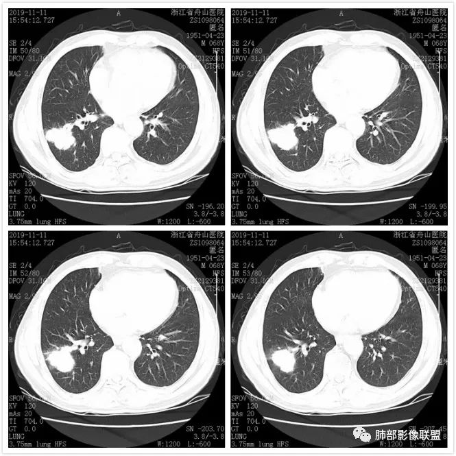 【病例】诡异的尿路肺转移瘤1例CT影像 【病例】诡异的尿路肺转移瘤1例CT影像