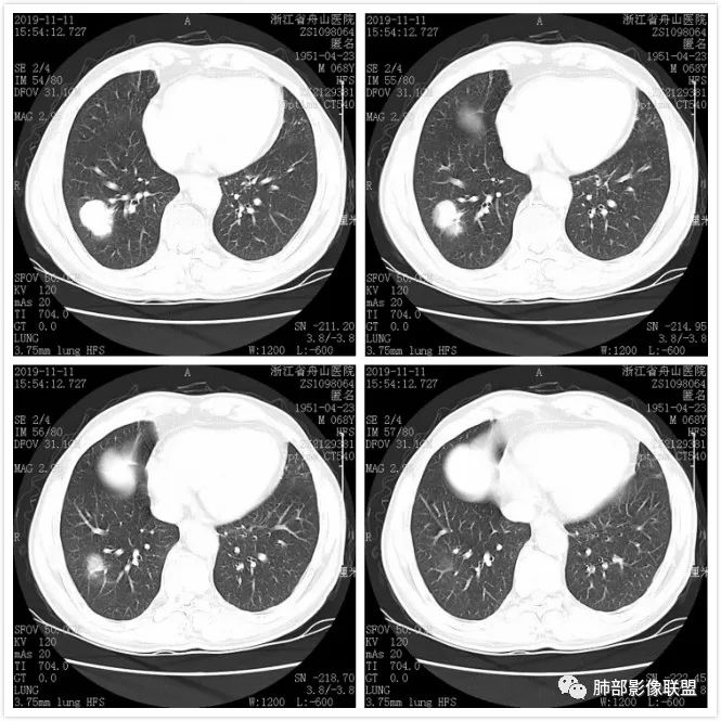 【病例】诡异的尿路肺转移瘤1例CT影像 【病例】诡异的尿路肺转移瘤1例CT影像