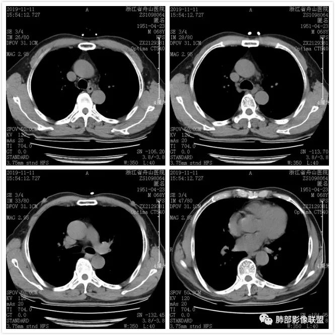 【病例】诡异的尿路肺转移瘤1例CT影像 【病例】诡异的尿路肺转移瘤1例CT影像