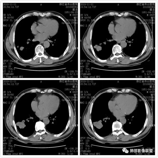 【病例】诡异的尿路肺转移瘤1例CT影像 【病例】诡异的尿路肺转移瘤1例CT影像